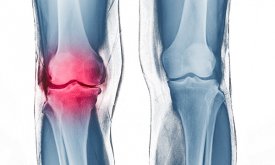 Rodilla