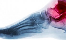 Artroscòpia de turmell