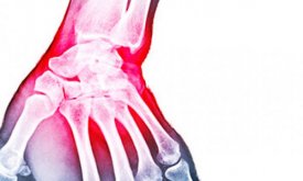 Fractura de radi distal