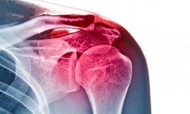 Inestabilitat d’espatlla